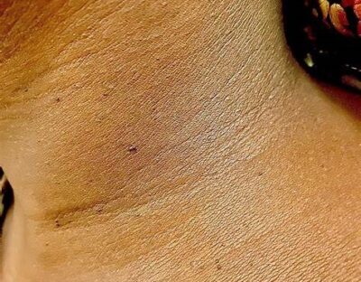 קורס סרחי עור – מפגש מקצועי וממוקד