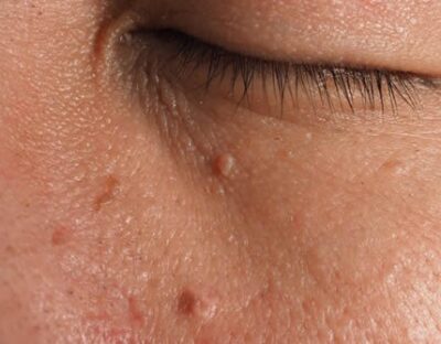 קורס סרחי עור – מפגש מקצועי וממוקד